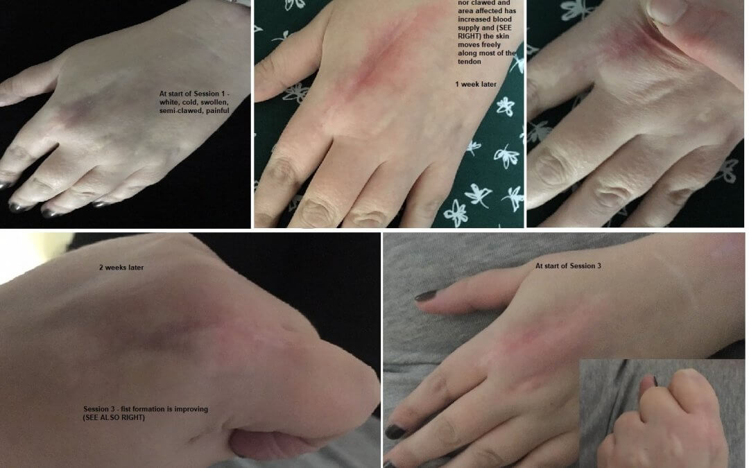 Scar tissue damage can improve even decades later!